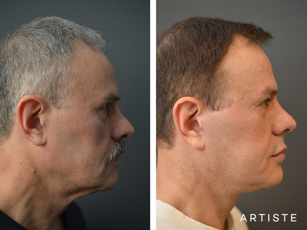 face lift