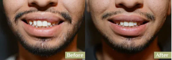 before and after image of a man who's just undergone surgery