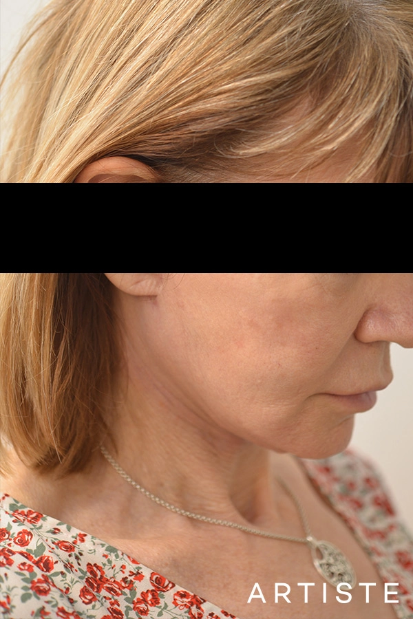 60 Year Old Female Neck Lift