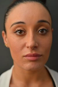 Rhinoplasty before