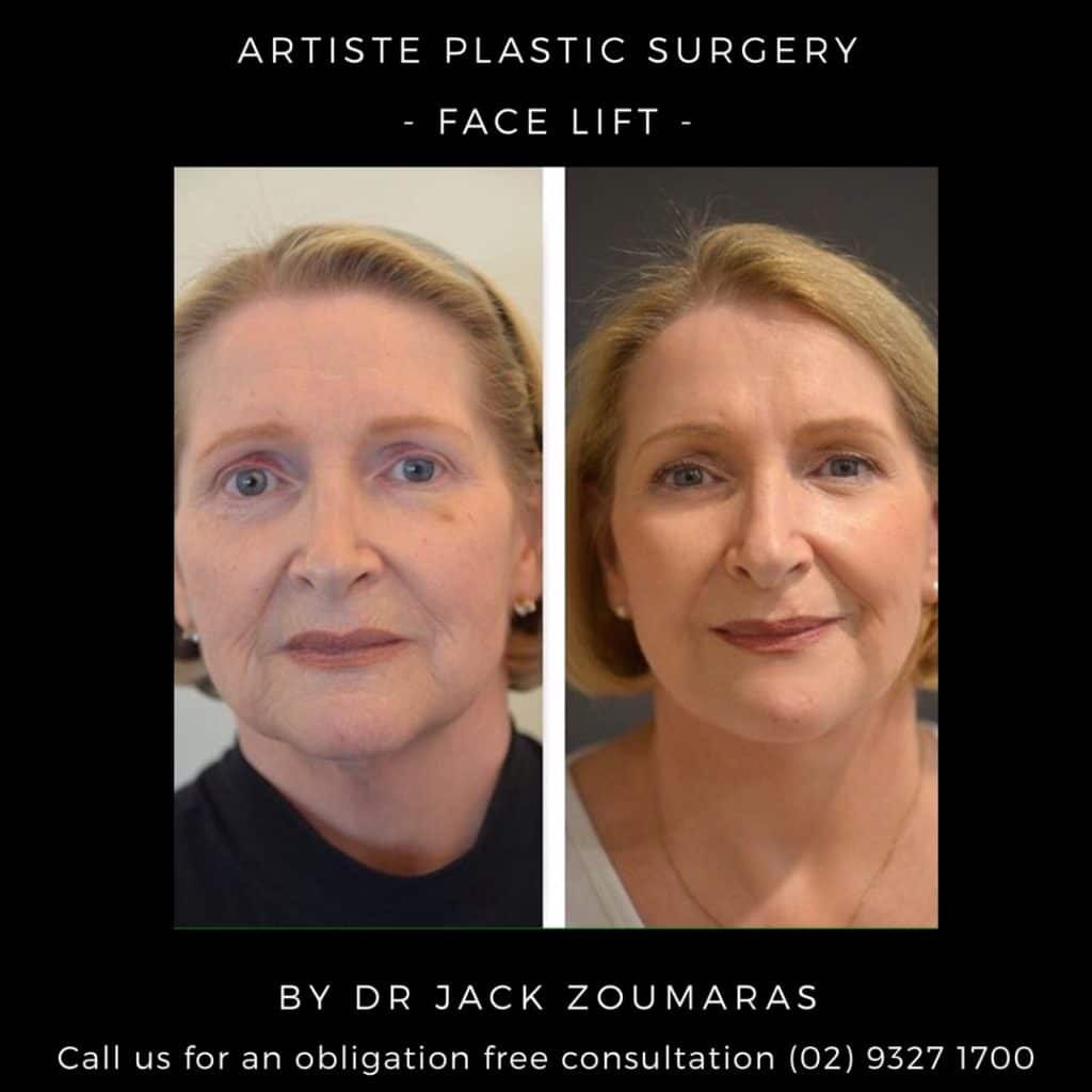 Artiste Plastic Surgery - Facelift Before and After Photos