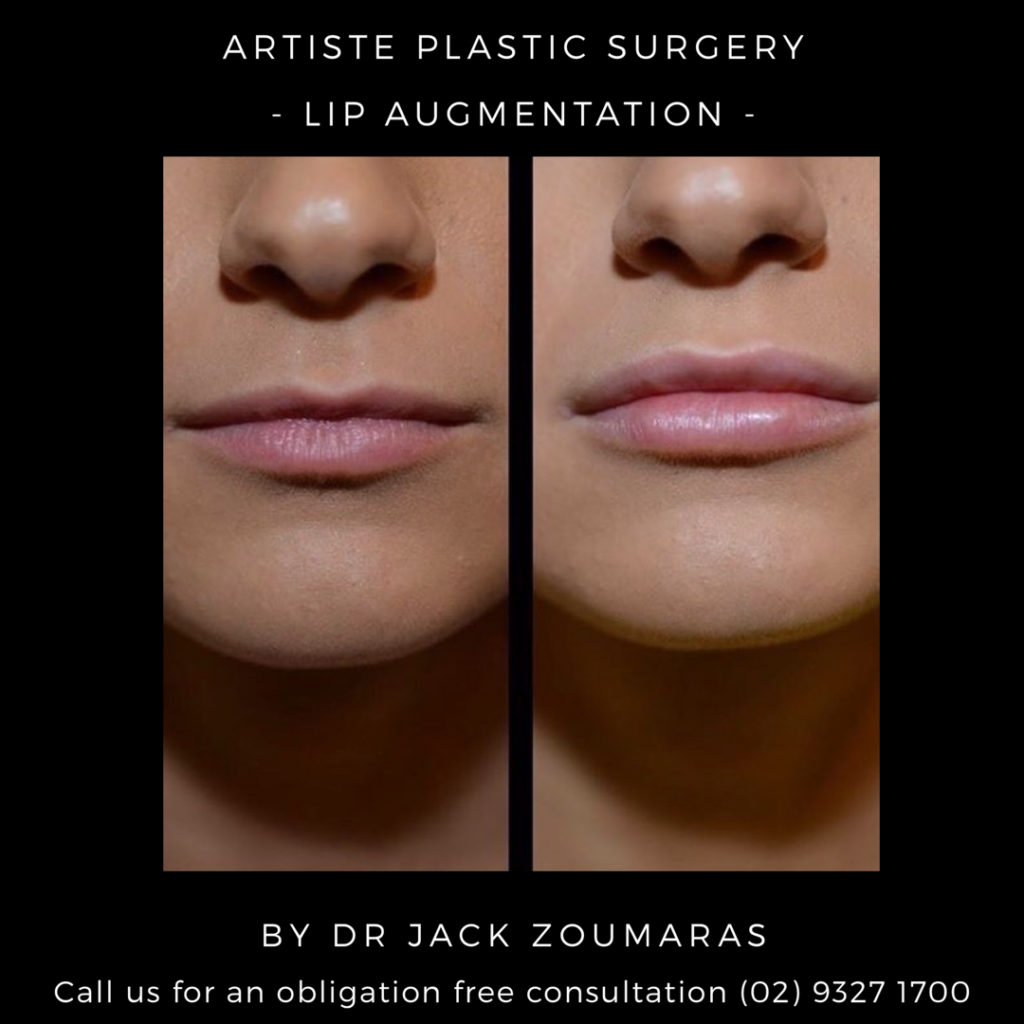 Lip Augmentation Surgery by Dr Jack Zoumaras