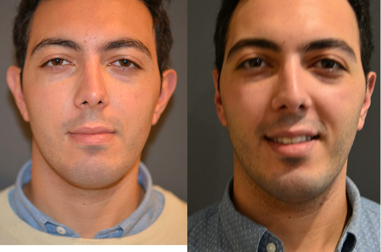Ear correction without surgery adults discount