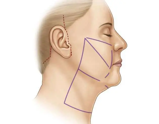 Figure 1: Full Facelift Incision