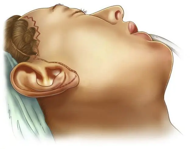 Figure 2: Short-Scar Facelift Incision