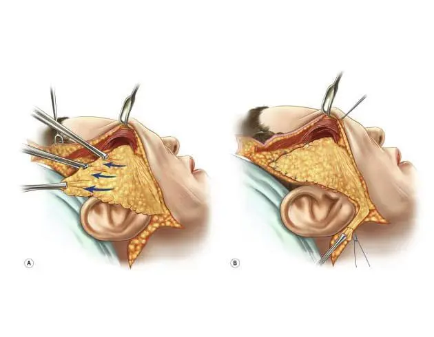 Figure 3: Typical Design, Lifting (A) and Inset (B) of a High SMAS Flap