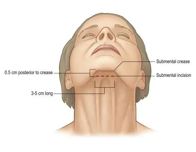 Figure 4: Submental Incision