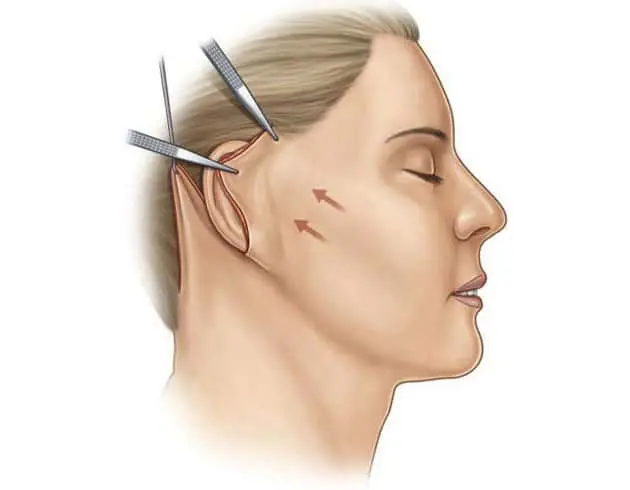 Figure 5: Re-draping of Facial Skin Allowing Removal of Excess Skin