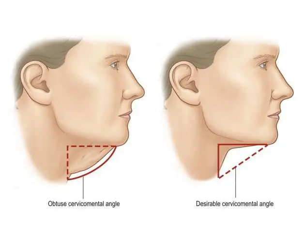 Figure 6: Re-draping of Neck Skin Figure 6