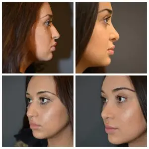 Rhinoplasty