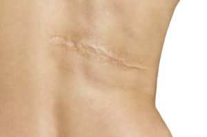Scar
