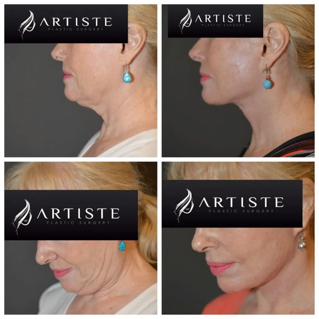 High SMAS Facelift at Artiste