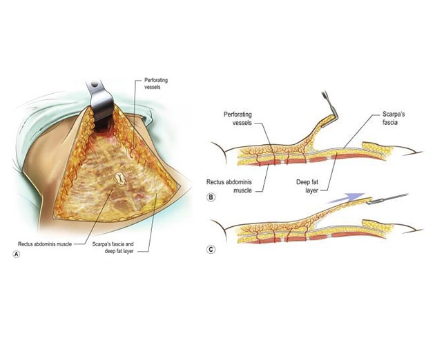 Abdominal flap illustrating underlying rectus muscle