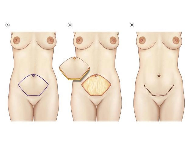 Routine Abdominoplasty Incision with Removal of skin and fat after tightening of the rectus muscle