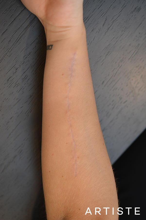 Tattoo Removal in Sydney | Artiste Plastic Surgery Tattoo Removal in Sydney | Artiste Plastic Surgery