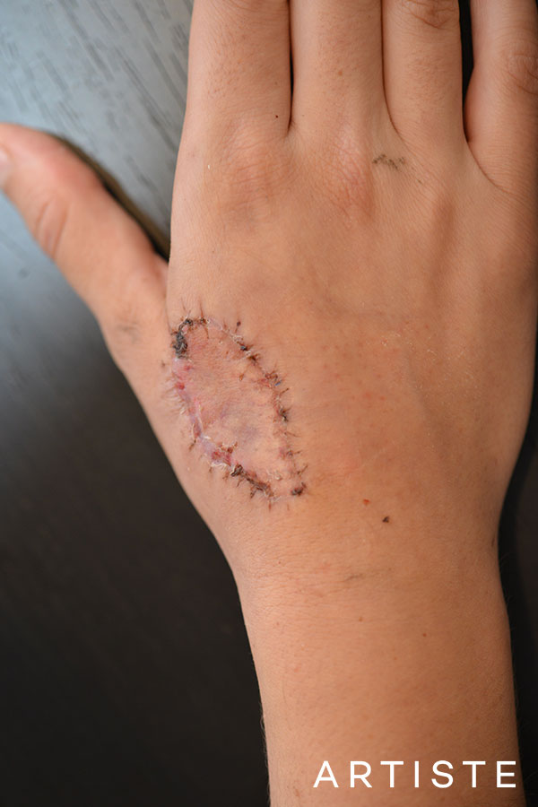 Tattoo Removal in Sydney | Artiste Plastic Surgery Tattoo Removal in Sydney | Artiste Plastic Surgery