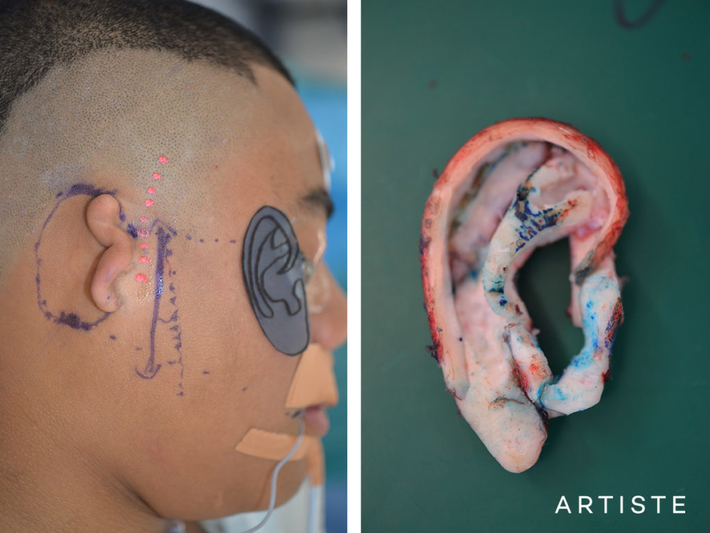 10 Year Old Partial Ear Reconstruction Microtia