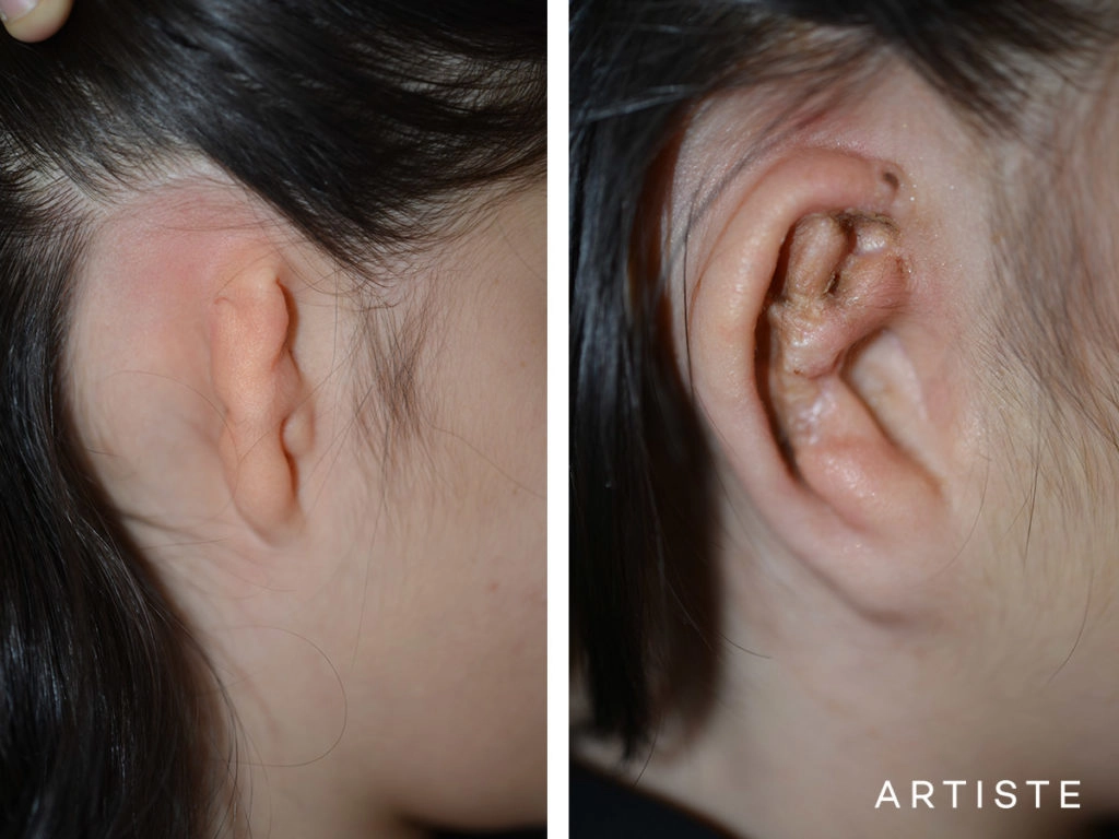 11 Year Old Ear Reconstruction