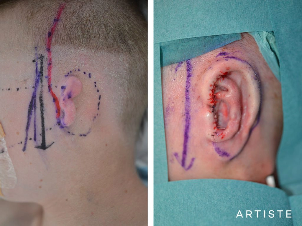 12 Year Old Ear Reconstruction Microtia