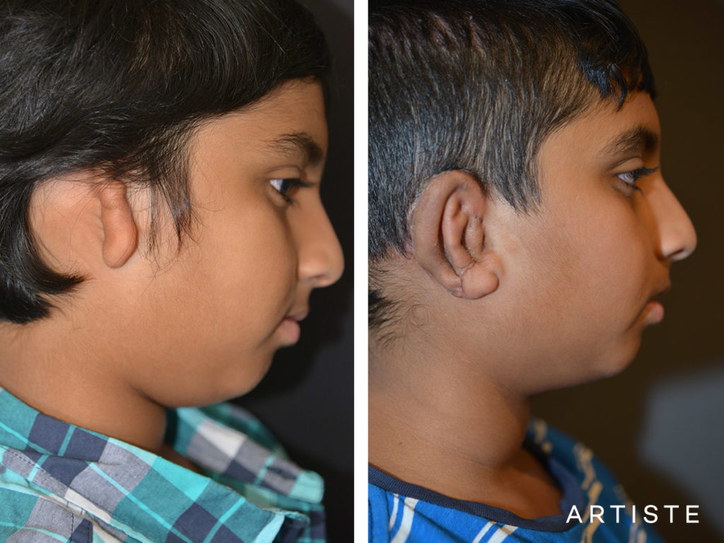 12 Year Old Partial Ear Reconstruction Microtia