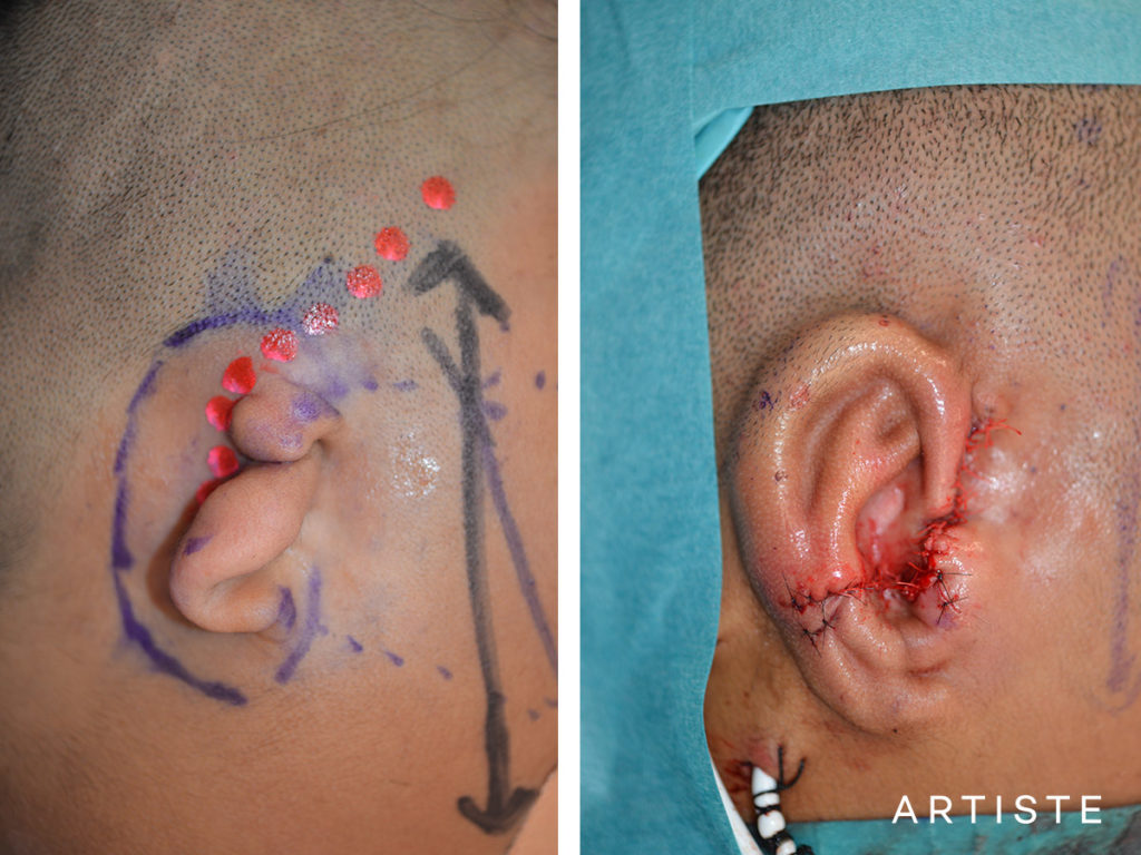 13 Year Old Ear Reconstruction Microtia