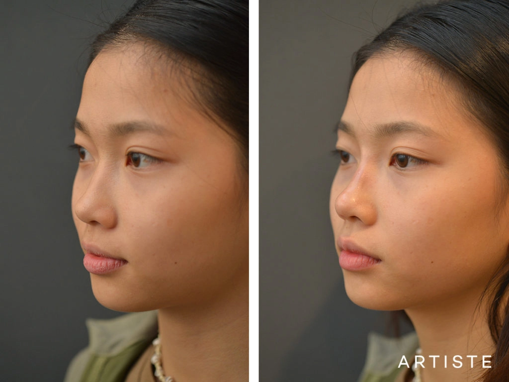 19 Years Old F Augmentation Asian Rhinoplasty