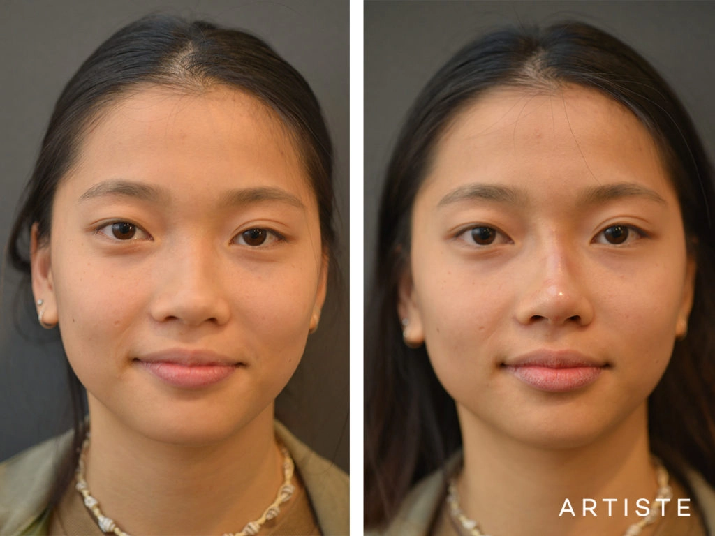 19 Years Old F Augmentation Asian Rhinoplasty