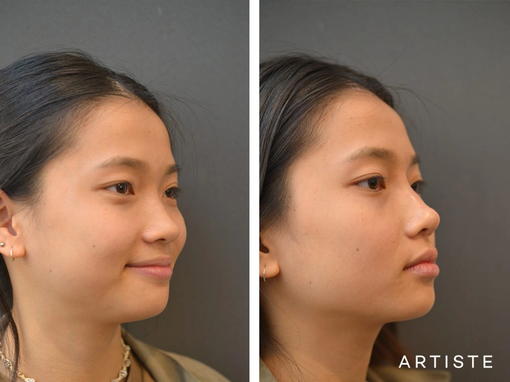 19 Years Old F Augmentation Asian Rhinoplasty