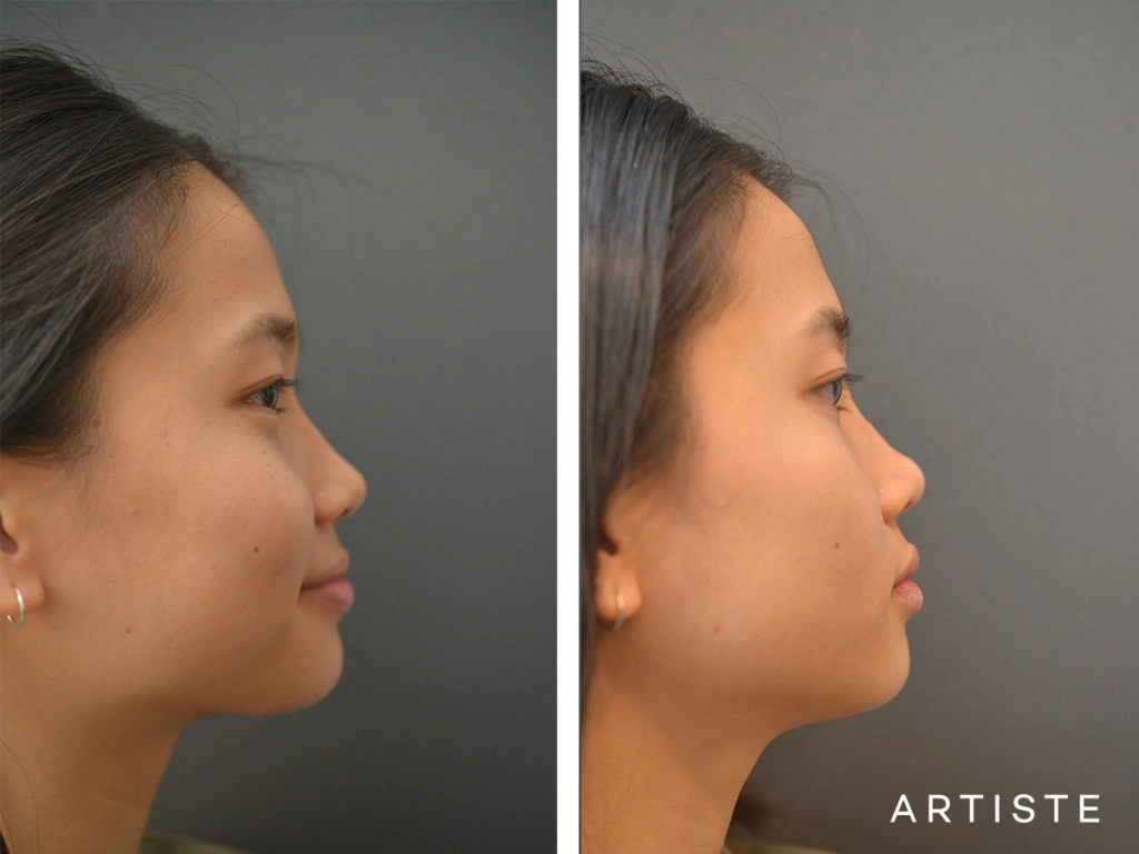 19 Years Old F Augmentation Asian Rhinoplasty