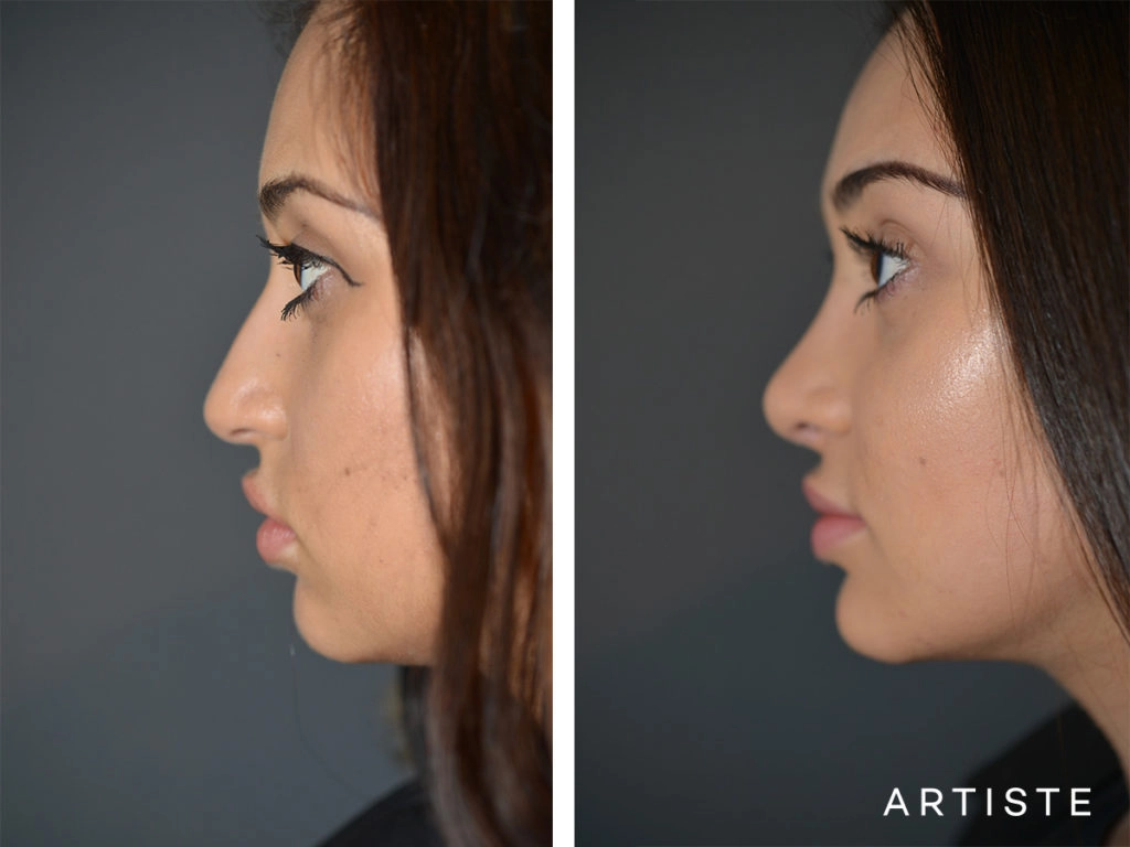 19 Years Old Total Nose Rhinoplasty