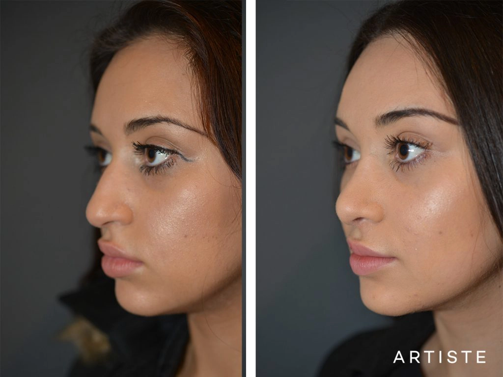 19 Years Old Total Nose Rhinoplasty