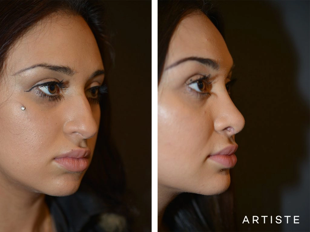 19 Years Old Total Nose Rhinoplasty