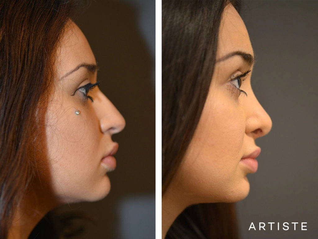 19 Years Old Total Nose Rhinoplasty