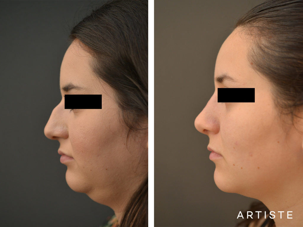 25 Year Old Dorsal + Tip Rhinoplasty