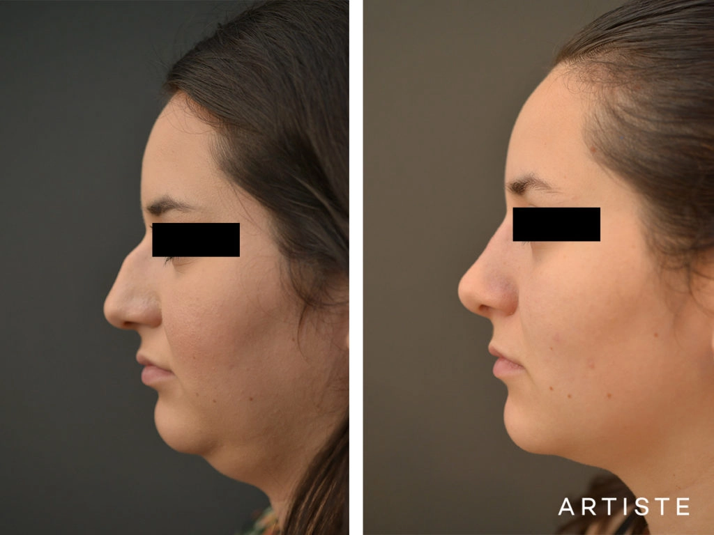 25 Year Old Dorsal + Tip Rhinoplasty