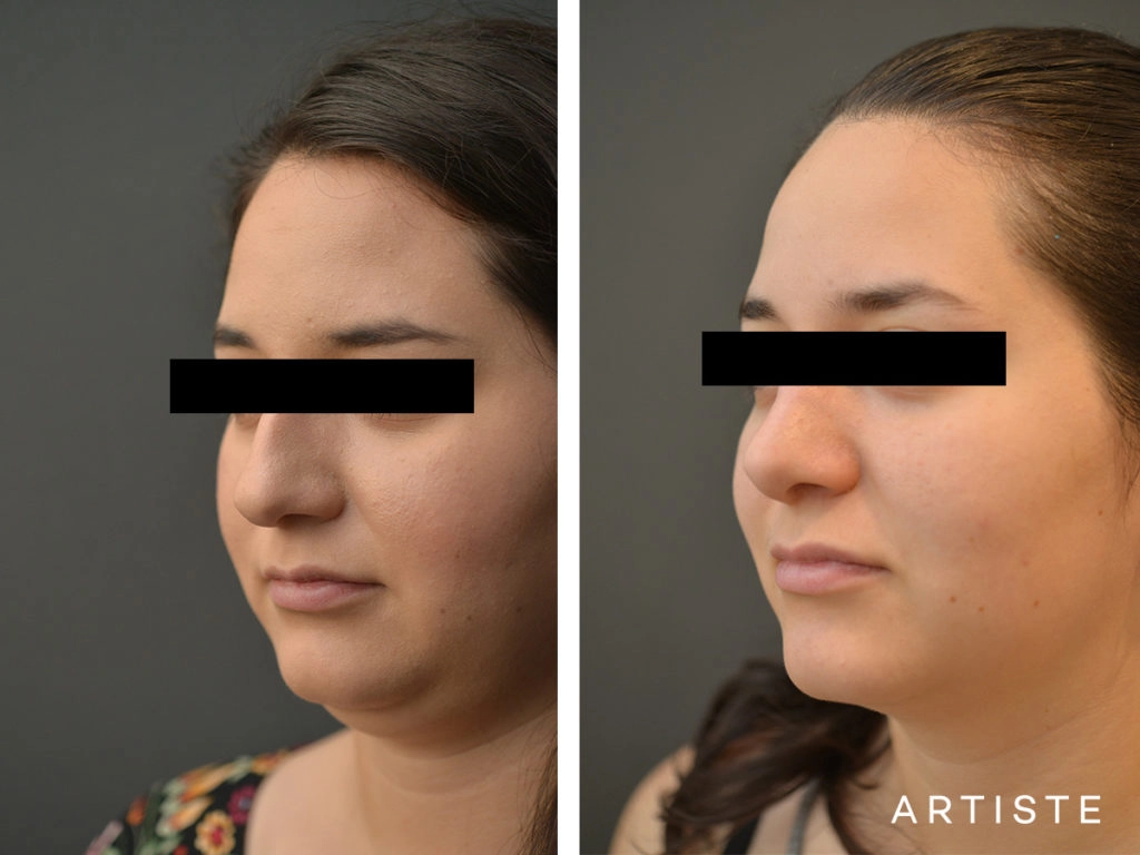 25 Year Old Dorsal + Tip Rhinoplasty