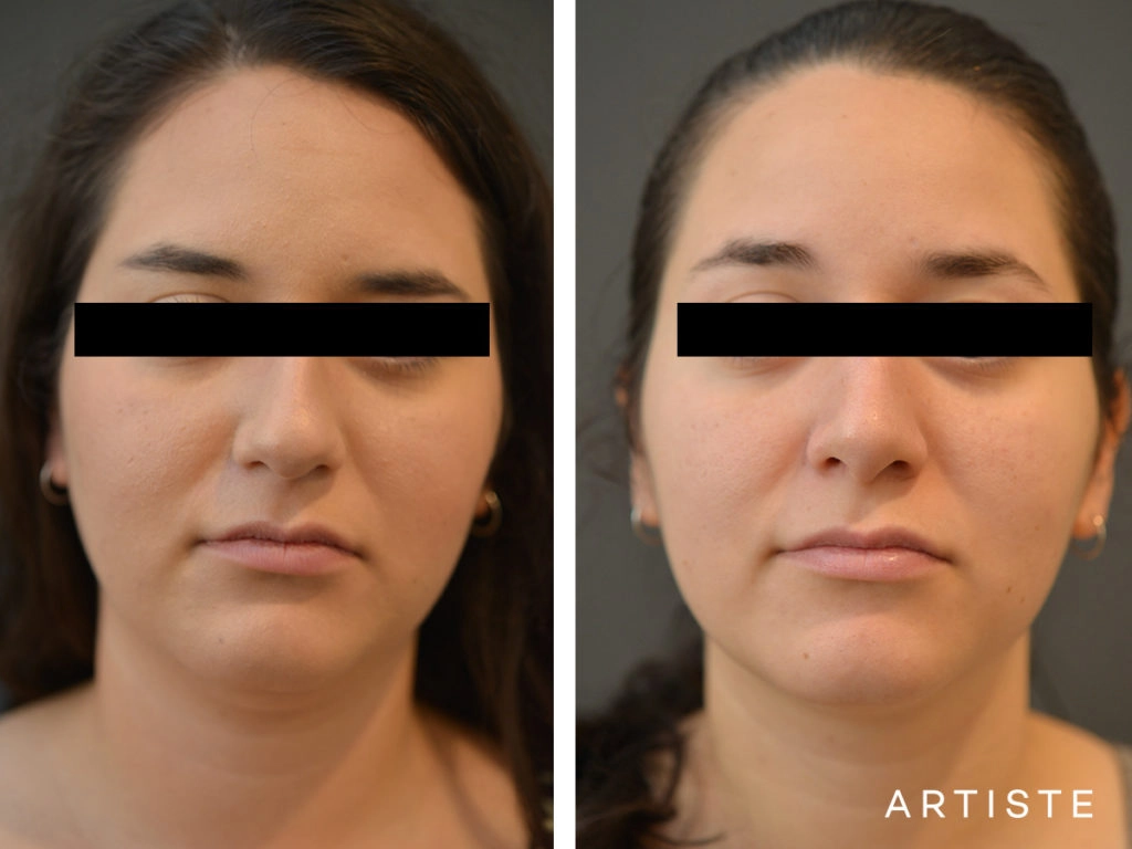 25 Year Old Dorsal + Tip Rhinoplasty