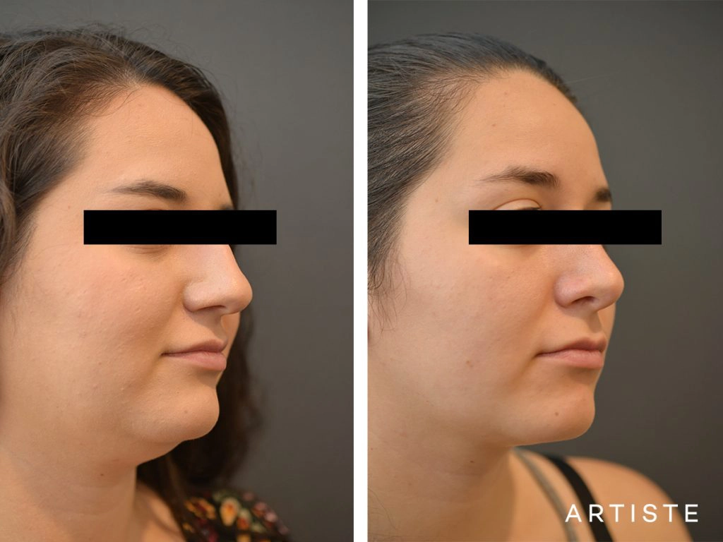 25 Year Old Dorsal + Tip Rhinoplasty