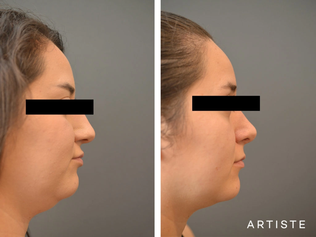 25 Year Old Dorsal + Tip Rhinoplasty