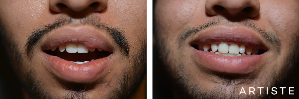 25 Year Old Male Scar Revision Upper Left Lip