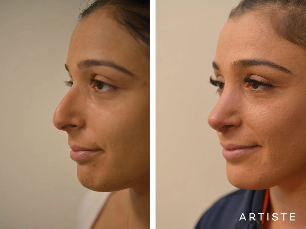 25 Years Old Dorsal Reduction Rhinoplasty