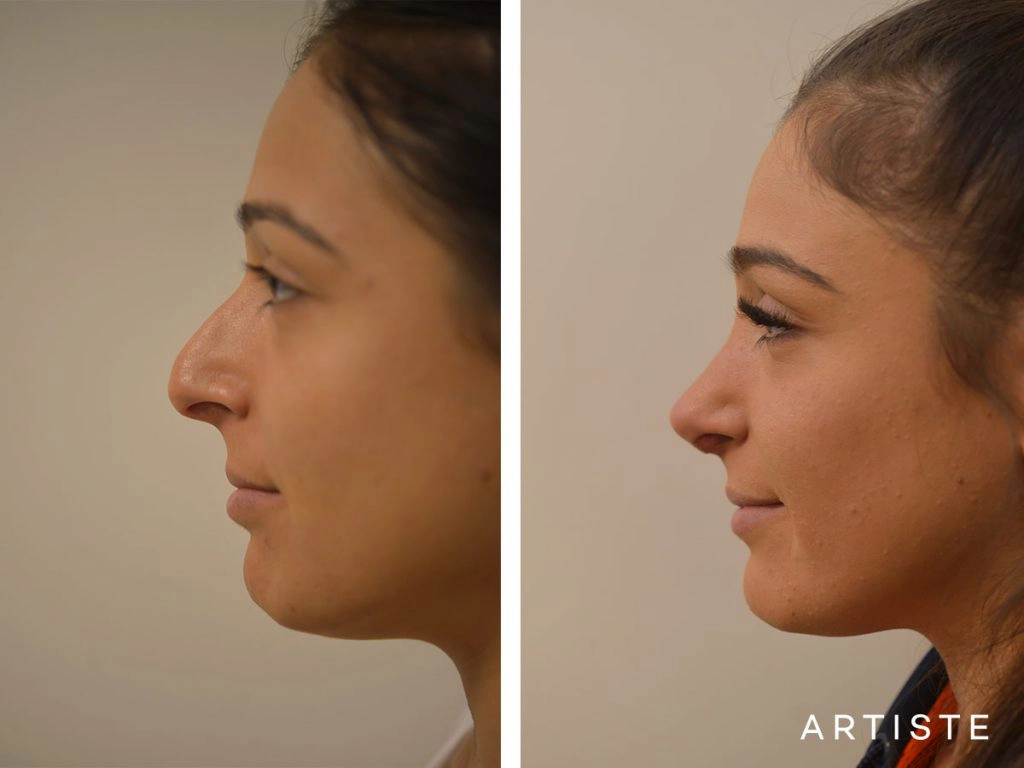 25 Years Old Dorsal Reduction Rhinoplasty