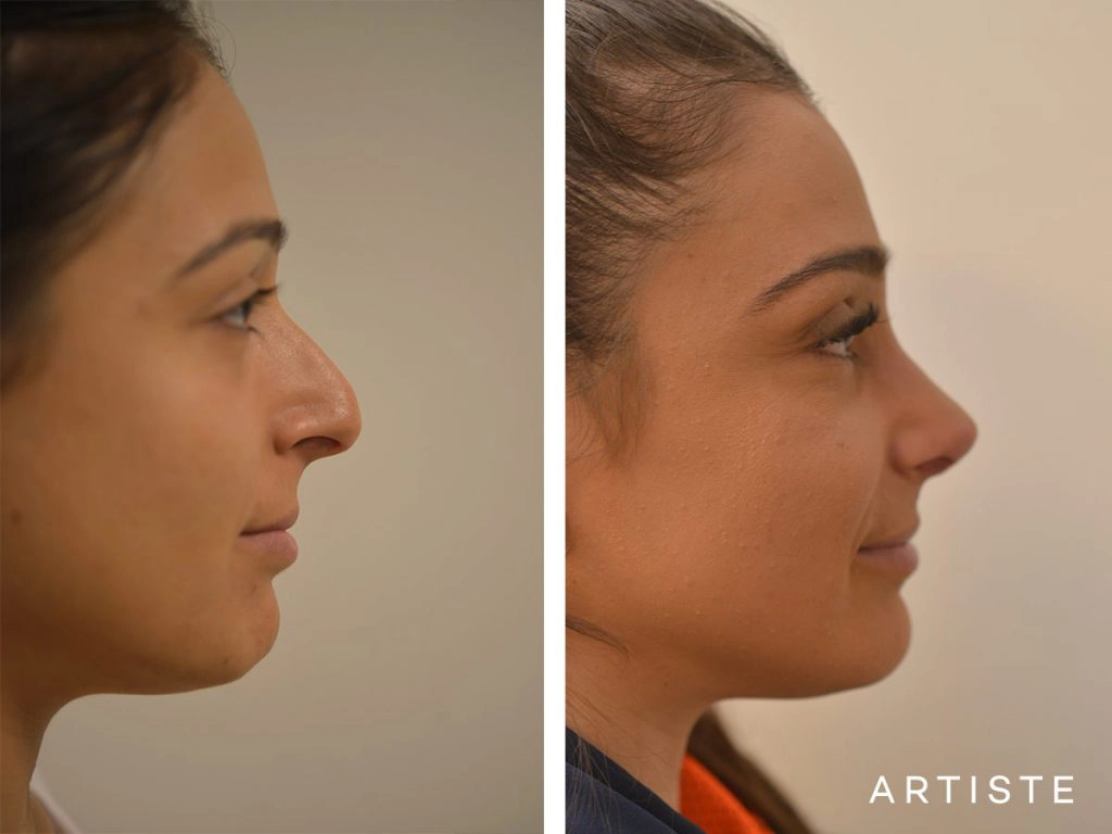 25 Years Old Dorsal Reduction Rhinoplasty