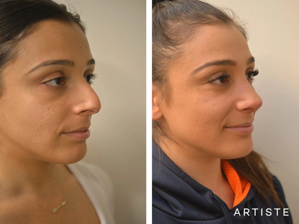 25 Years Old Dorsal Reduction Rhinoplasty