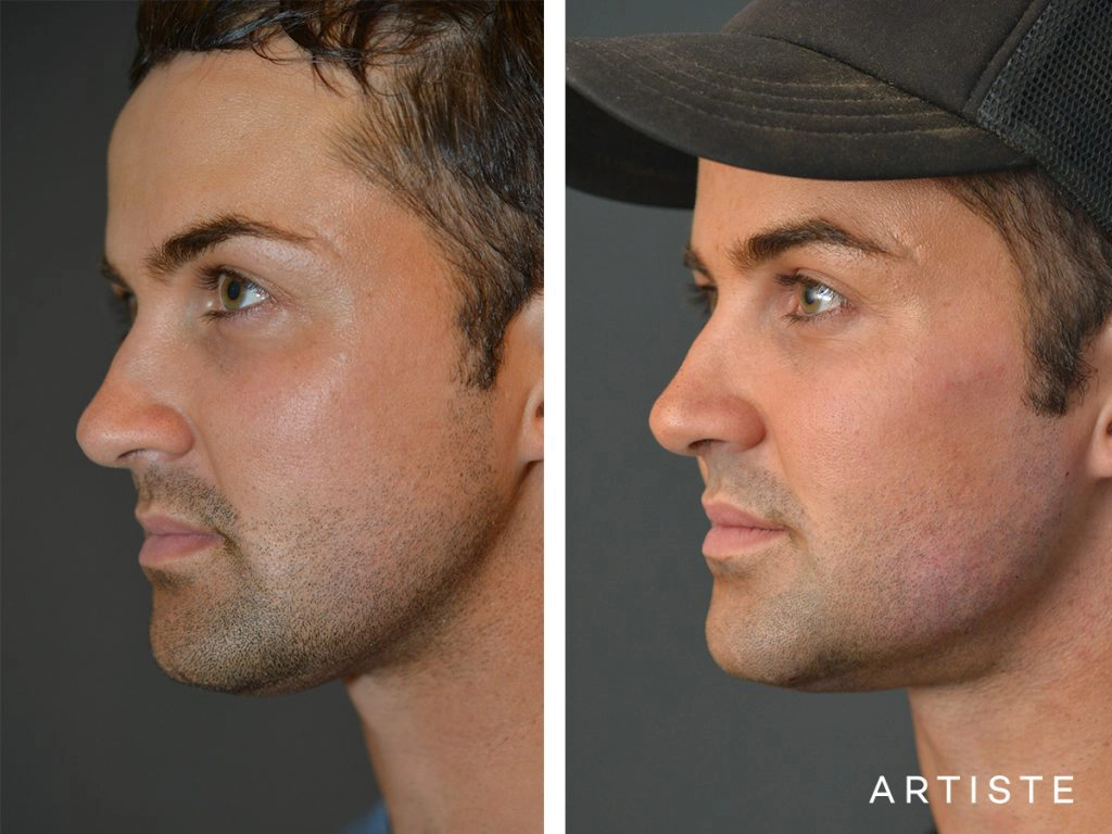 25 Years Old Facial Fillers and Neck Liposuction