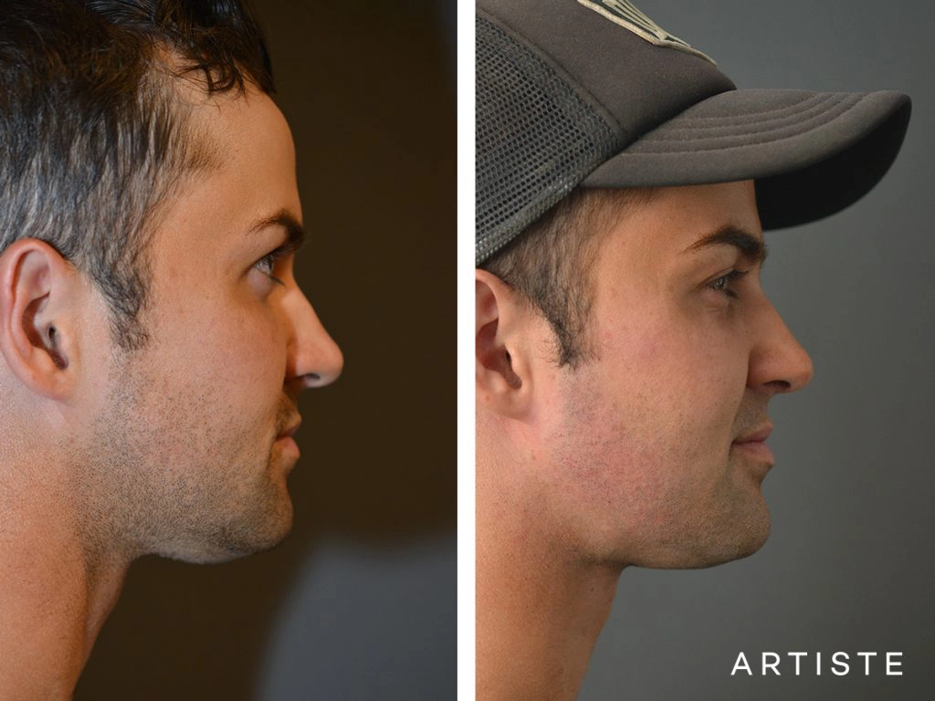 25 Years Old Facial Fillers and Neck Liposuction