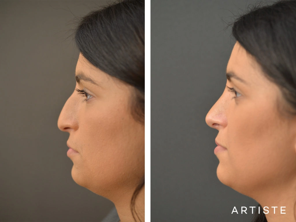 25 Years Old Total Nose Rhinoplasty