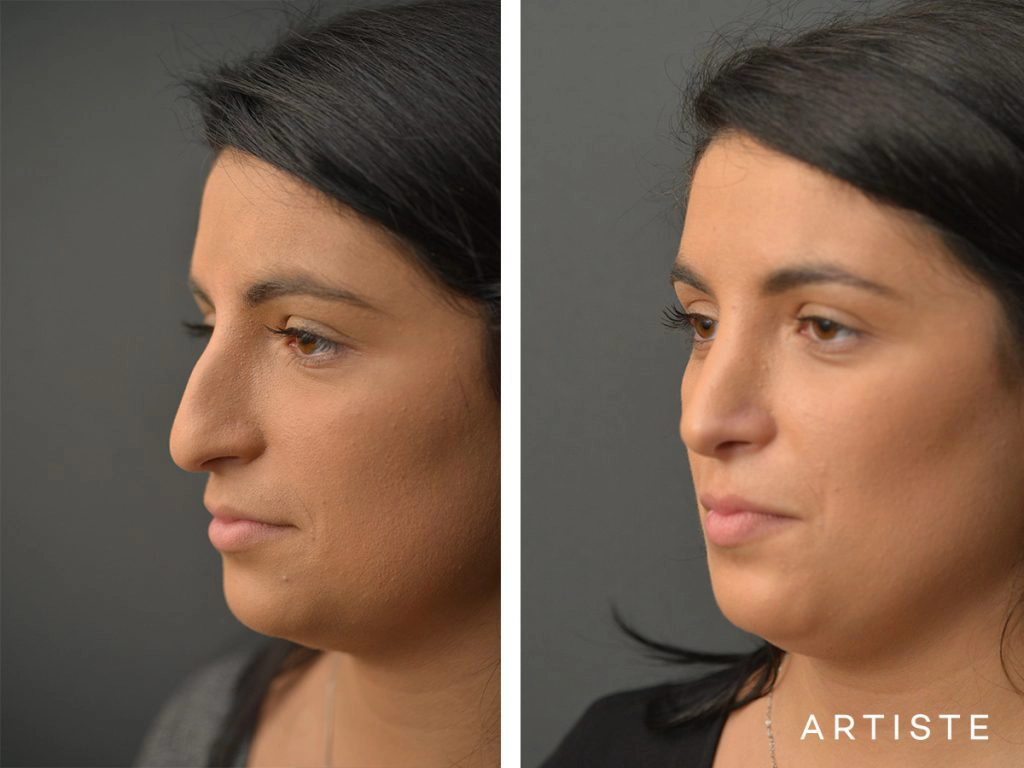 25 Years Old Total Nose Rhinoplasty