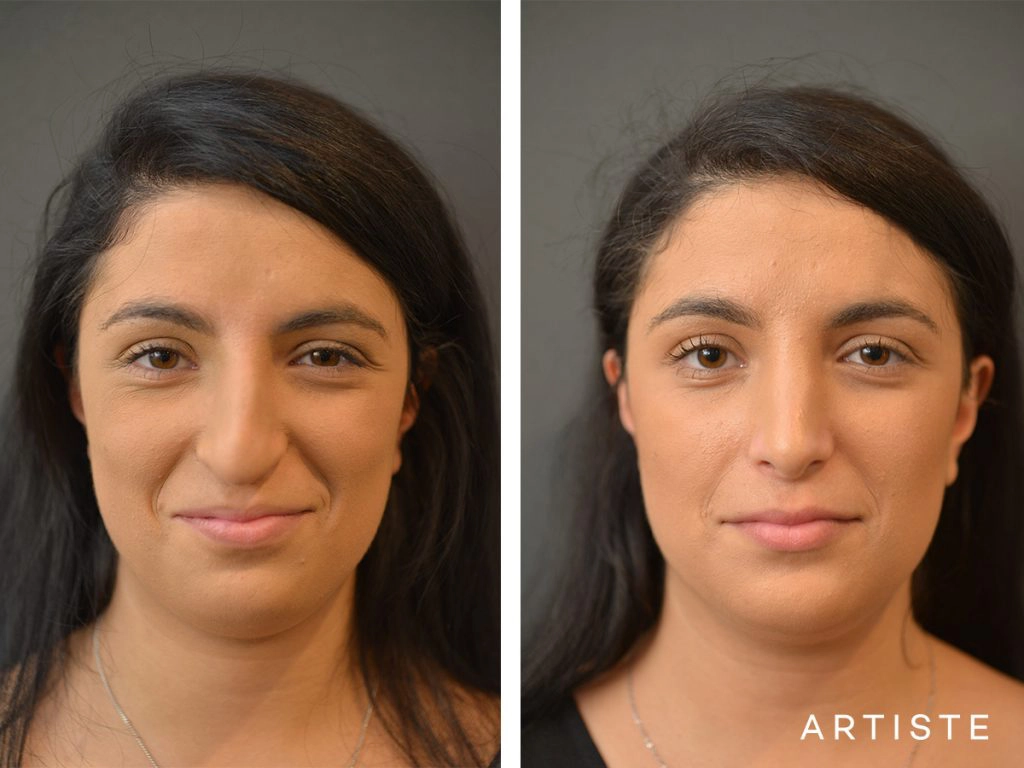 25 Years Old Total Nose Rhinoplasty