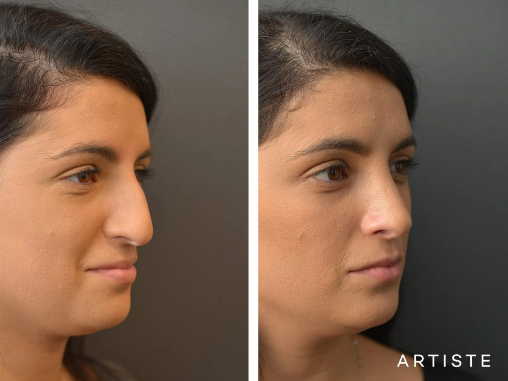 25 Years Old Total Nose Rhinoplasty